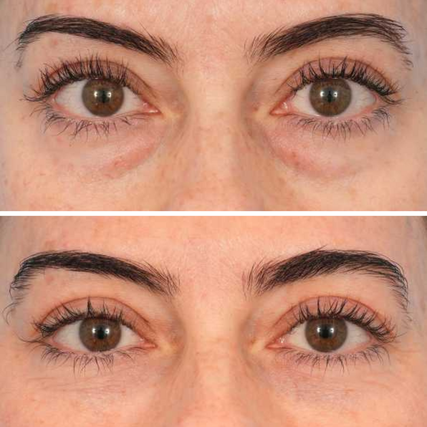 InstaLift PDRN & Collagen Eye Patches