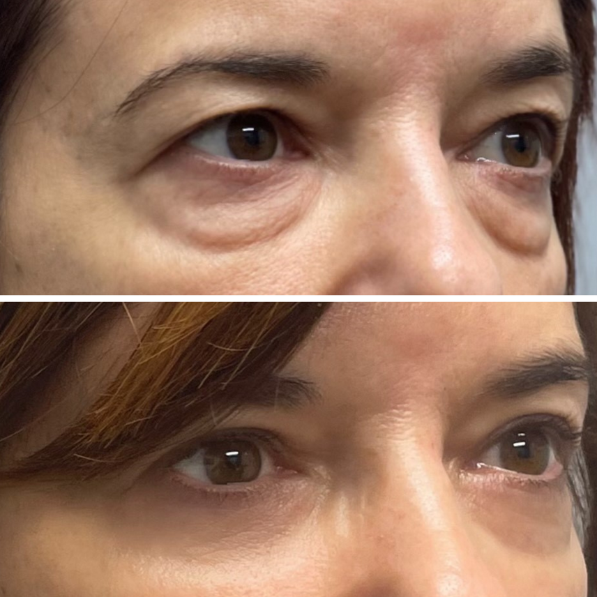 InstaLift PDRN & Collagen Eye Patches (8 Pairs)